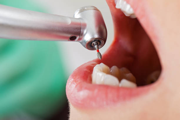 Best Emergency Wisdom Tooth Extraction in Rogers, MN